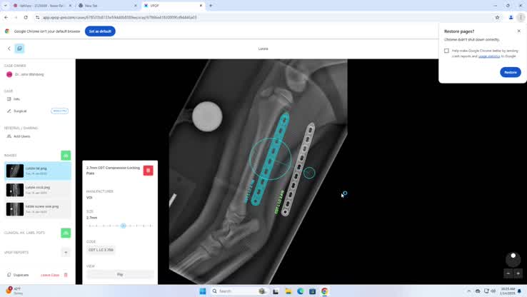 Lutzie Wallace: L Tib/FIb Fx Repair